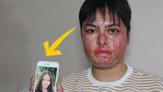 'Aynaya bakamıyorum, eski ben değilim artık' İş kazasında vücudunun yüzde 80'i yandı! 'Güneşe bile çıkamıyorum'