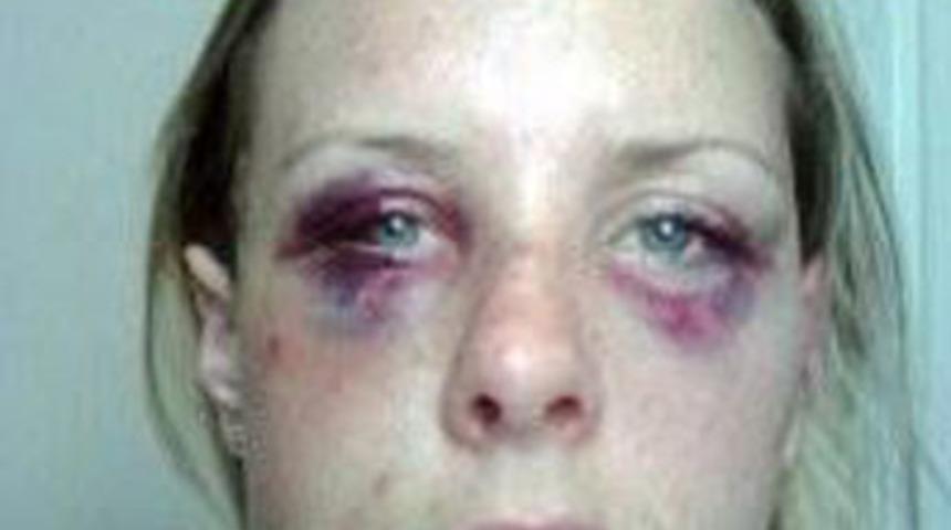 Sevgilisi bu hale getirdi