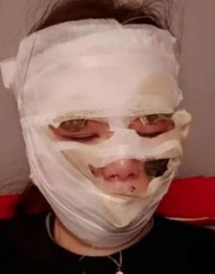 Düğün günü kabusa döndü! Kutlamada kullanılan spreyler bir anda alev aldı... Gelinin yüzü tamamen yandı G3