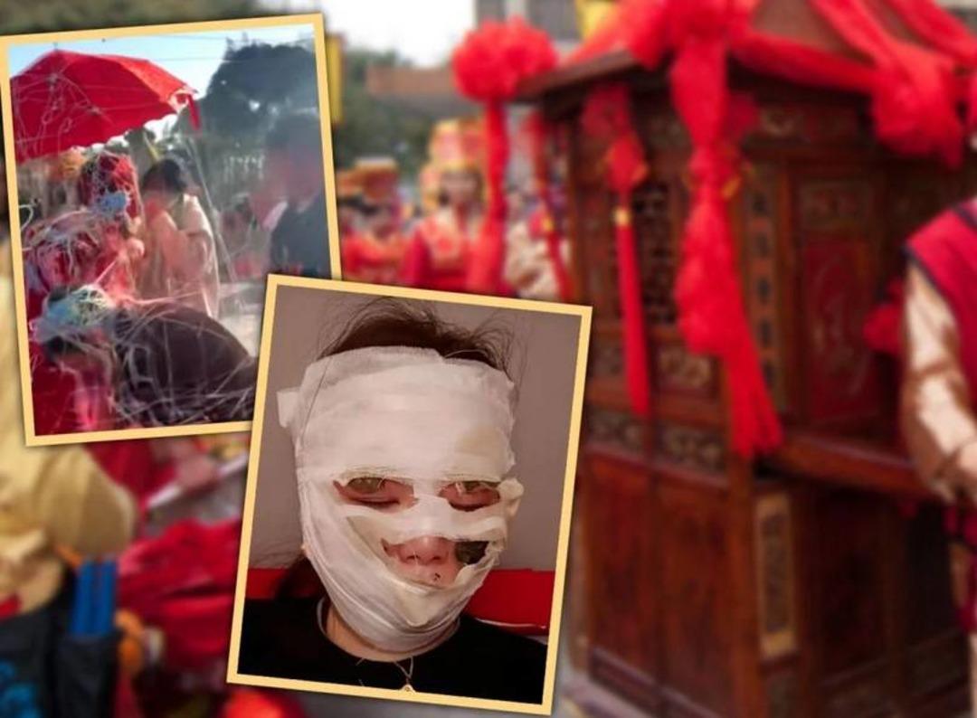 D&uuml;ğ&uuml;n g&uuml;n&uuml; kabusa d&ouml;nd&uuml;! Kutlamada kullanılan spreyler bir anda alev aldı... Gelinin y&uuml;z&uuml; tamamen yandı