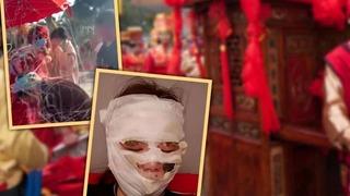 Düğün günü kabusa döndü! Kutlamada kullanılan spreyler bir anda alev aldı... Gelinin yüzü tamamen yandı