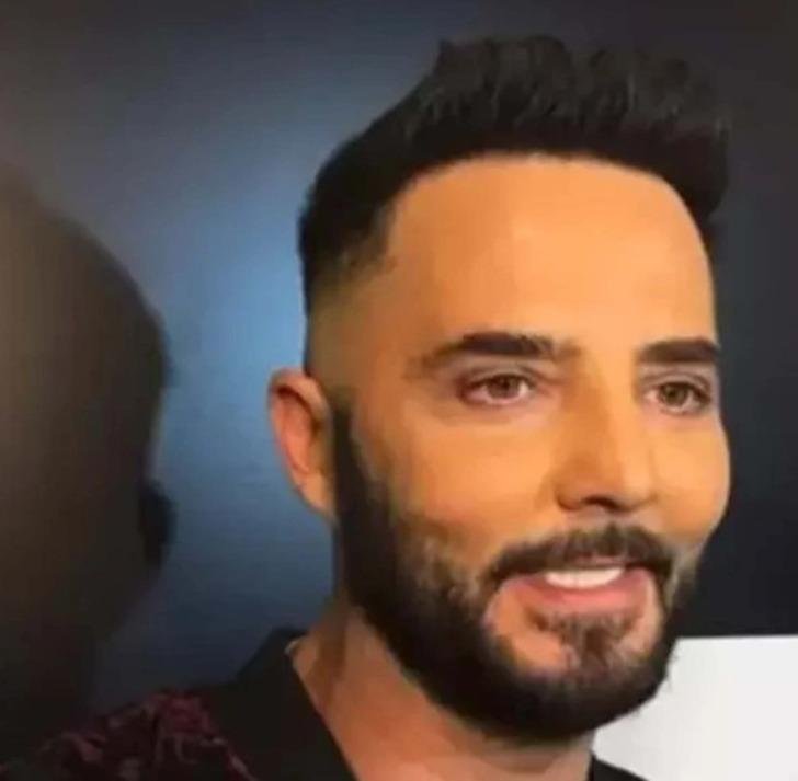 Yüzündeki değişim olay oldu! Gökhan Özen botoks iddialarına böyle cevap verdi G1