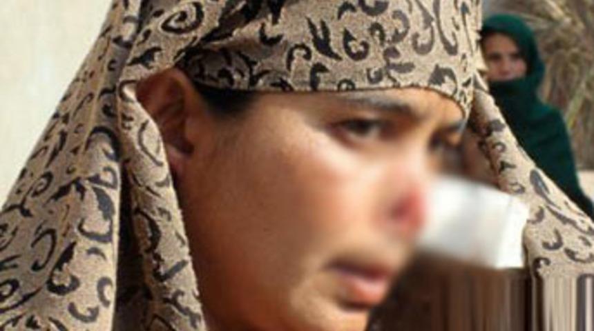 Burnu kesilen kadın dramını anlattı