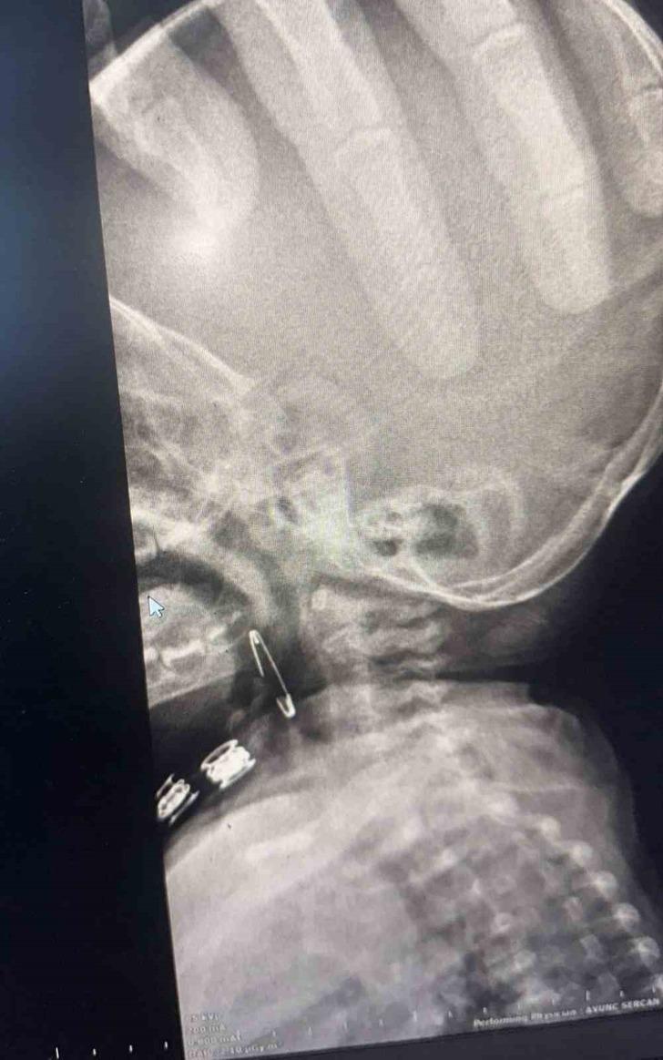 Bitlis'te 8 aylık bebeğin boğazına çengelli iğne kaçtı! Röntgen görüntüsünü gören şaştı kaldı G2