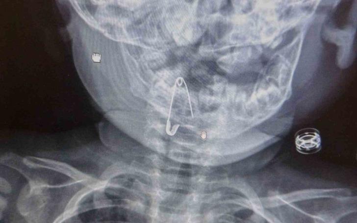 Bitlis'te 8 aylık bebeğin boğazına çengelli iğne kaçtı! Röntgen görüntüsünü gören şaştı kaldı G3