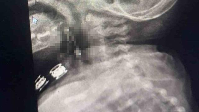 Bitlis'te 8 aylık bebeğin boğazına çengelli iğne kaçtı! Röntgen görüntüsünü gören şaştı kaldı