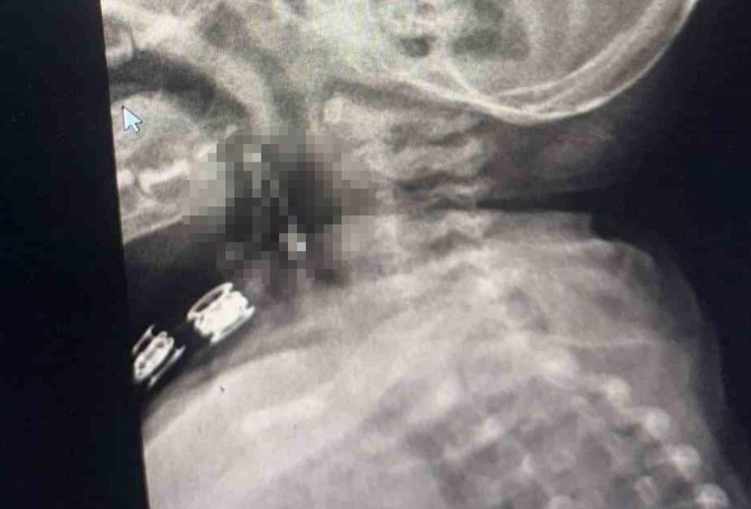 Bitlis'te 8 aylık bebeğin boğazına &ccedil;engelli iğne ka&ccedil;tı! R&ouml;ntgen g&ouml;r&uuml;nt&uuml;s&uuml;n&uuml; g&ouml;ren şaştı kaldı