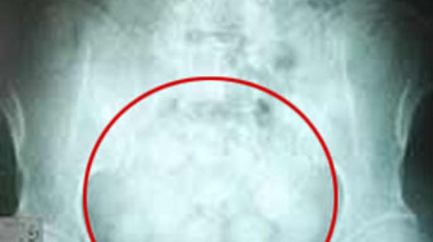 Midesinden 1 kilodan fazla kokain &ccedil;ıktı