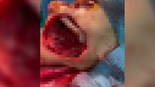 Yanağından ceviz büyüklüğünde tümör alınan kadın ölümden döndü! Göğsünden doku alınarak yeni bir yanak yapıldı