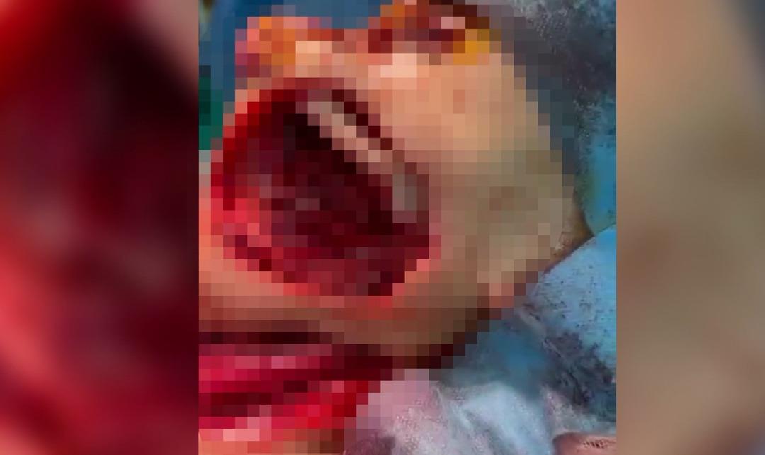 Yanağından ceviz b&uuml;y&uuml;kl&uuml;ğ&uuml;nde t&uuml;m&ouml;r alınan kadın &ouml;l&uuml;mden d&ouml;nd&uuml;! G&ouml;ğs&uuml;nden doku alınarak yeni bir yanak yapıldı