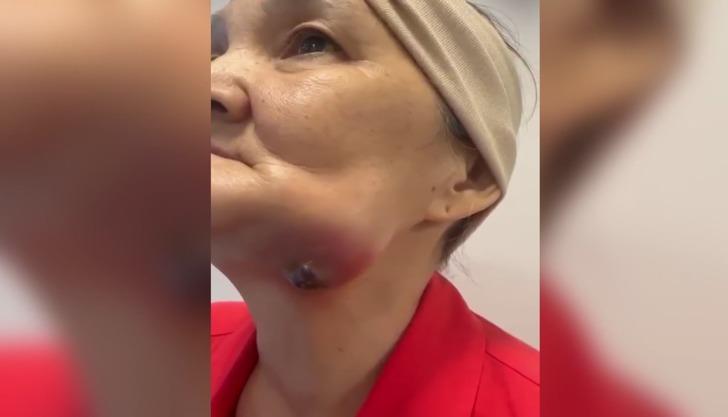 Yanağından ceviz büyüklüğünde tümör alınan kadın ölümden döndü! Göğsünden doku alınarak yeni bir yanak yapıldı G1