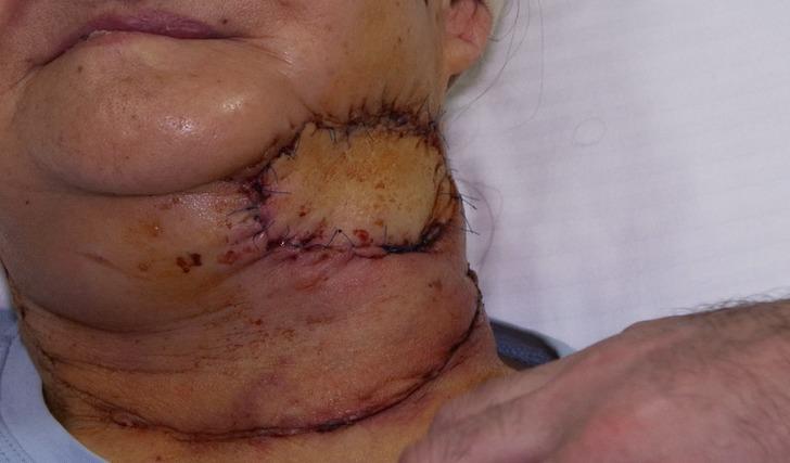 Yanağından ceviz büyüklüğünde tümör alınan kadın ölümden döndü! Göğsünden doku alınarak yeni bir yanak yapıldı G5