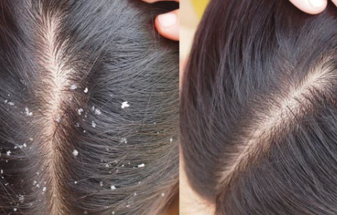 Kepeğe karşı en etkili form&uuml;l! Sadece 2 malzeme kepeğin k&ouml;k&uuml;n&uuml; kazıyor, tekrar oluşumunu engelliyor