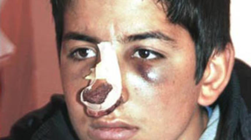 Asker &ouml;ğretmen burun kırdı