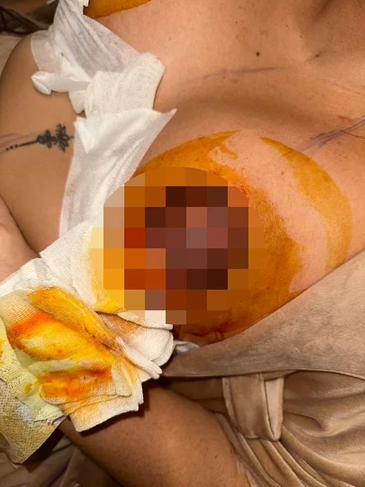 Meme dikleştirme ameliyatı için Türkiye'ye geldi, hayatı kabusa döndü! Arkadaşları meme uçlarının görüntülerini paylaştı G5