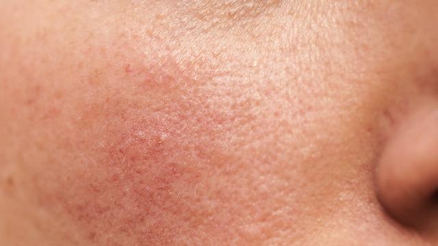 Gül hastalığı nedir? Gül hastalığı belirtileri ve tedavisi