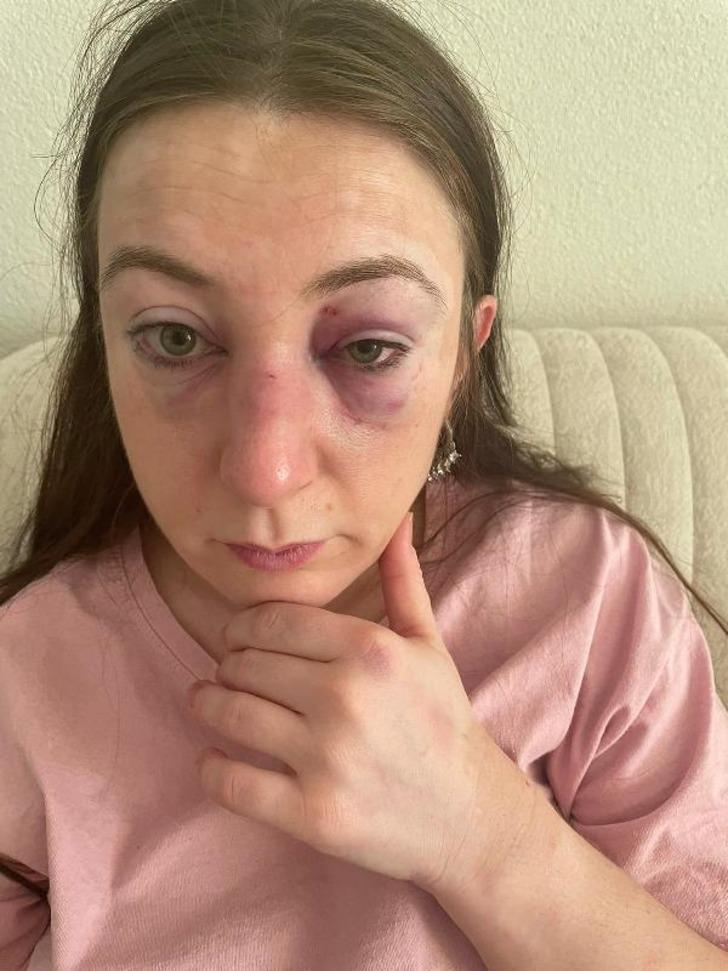 Eski sevgilisini eğlence mekanında görünce deliye döndü! 'Cinsel içerikli mesajların' ardından bir detay daha ortaya çıktı: 'Vücudumda defalarca sigara söndürdü' G1