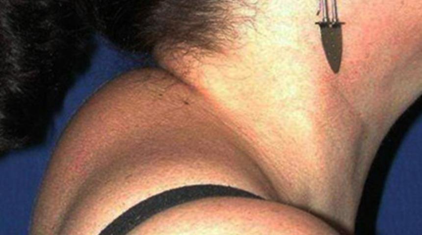 Cushing sendromu nedir? Cushing sendromu belirtileri nelerdir? Cushing sendromu tedavisi