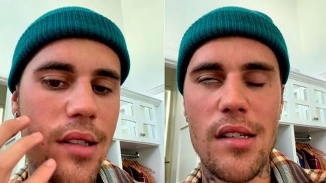 Ramsay Hunt Sendromu nedir, belirtileri nelerdir? Ramsay Hunt sendromu neden olur?