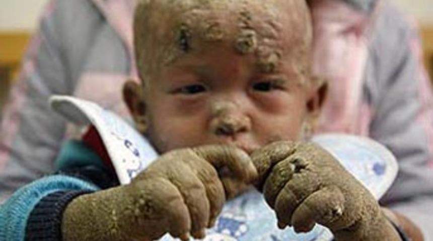 "Balık &ccedil;ocuk" doktorları şok etti!