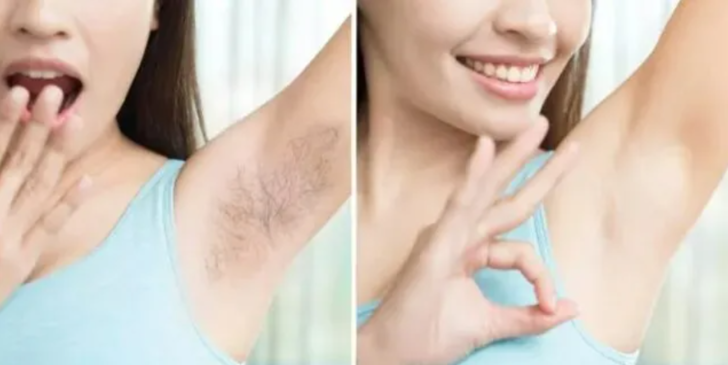 Denenmiş doğal epilasyon yöntemleri! İstenmeyen tüylerin kökünü kurutuyor! Tekrar çıkmasına izin vermiyor G4