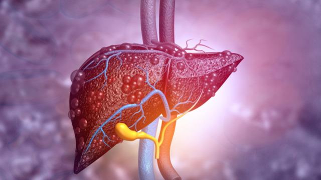 Karaciğerinizin sağlıksız olduğunu gösteren 7 işaret! Bu belirtilerden biri varsa hemen doktora koşun  