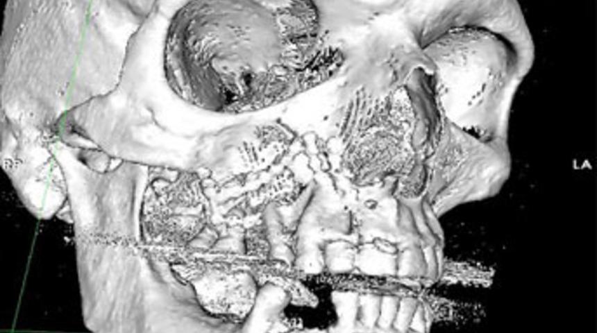 Par&ccedil;alanan y&uuml;z&uuml; eski haline getirildi