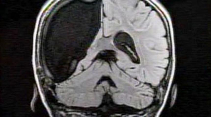 Beyninin yarısı yok