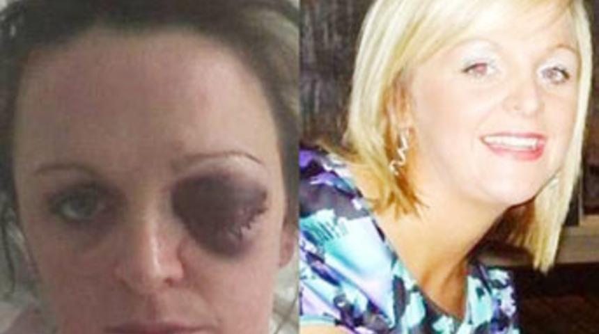 Dizi yıldızının g&ouml;z&uuml;n&uuml; &ccedil;ıkardı!