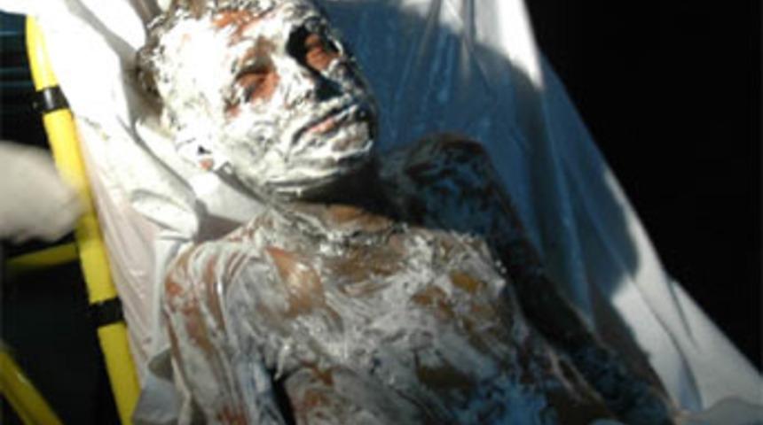 Arkadaşları tarafından tinerle yakıldı