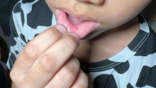 Öğretmenin sakız cezası ülkeyi karıştırdı! Sakız çiğneyen 36 öğrencisinin dudaklarını çengelli iğneyle deldi