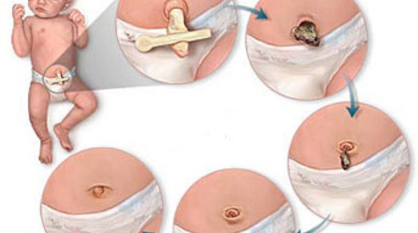 G&ouml;bek kordonu ne zaman kesilir?