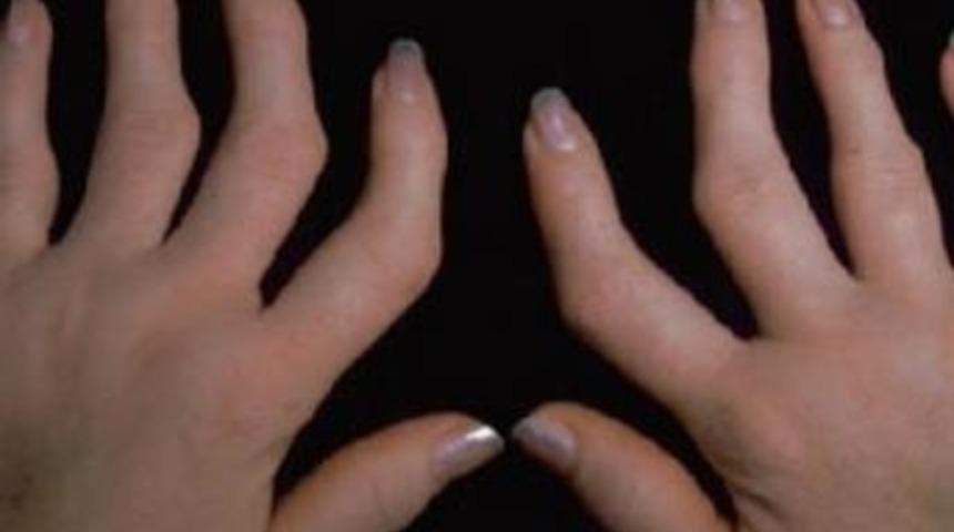 Romatizma ağrılarına destek &ccedil;&ouml;z&uuml;mler