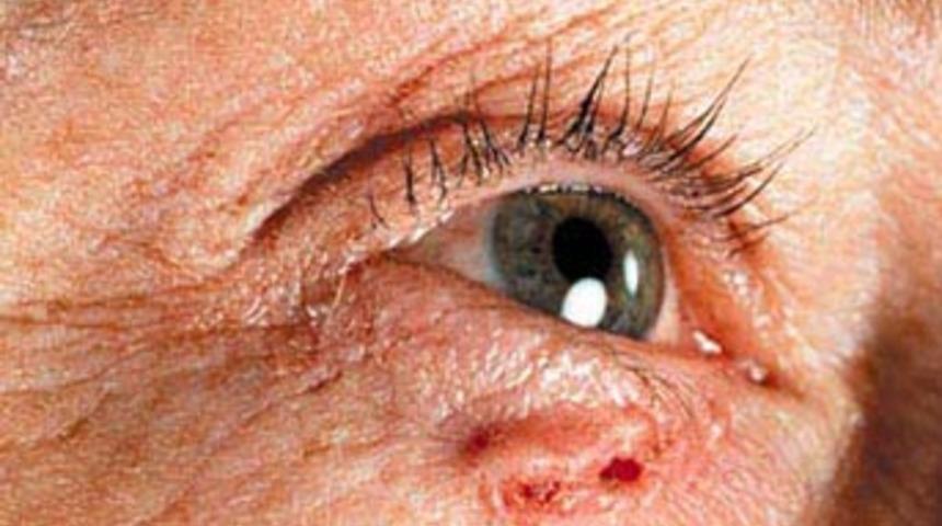 Deri kanseri neden artıyor?