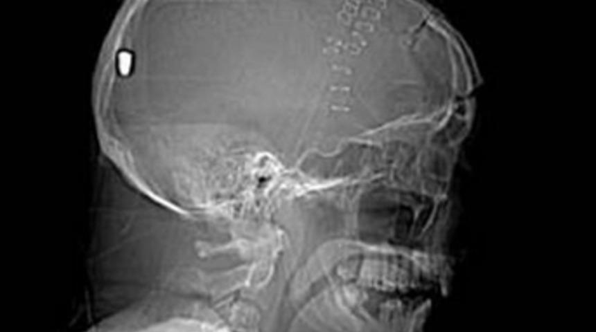 Kafatasına saplanan merminin gizi &ccedil;&ouml;z&uuml;lemedi!