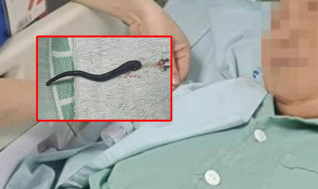 Aralıksız olarak burnu kanayan kadın doktorları da şaşırttı! Burnundan &ouml;yle bir şey &ccedil;ıktı ki... G&uuml;nlerce orada yaşamış 