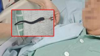 Aralıksız olarak burnu kanayan kadın doktorları da şaşırttı! Burnundan öyle bir şey çıktı ki... Günlerce orada yaşamış 