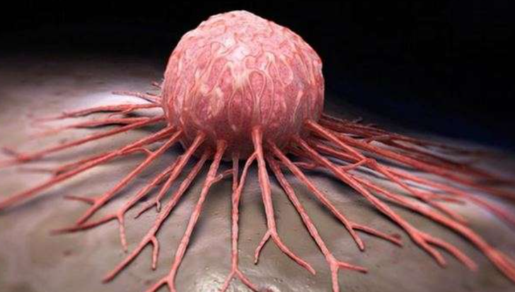 Yemek yerken fark edebileceğiniz 3 kanser belirtisi! Üç hafta boyunca devam ediyorsa sonucu ciddi olabilir G1