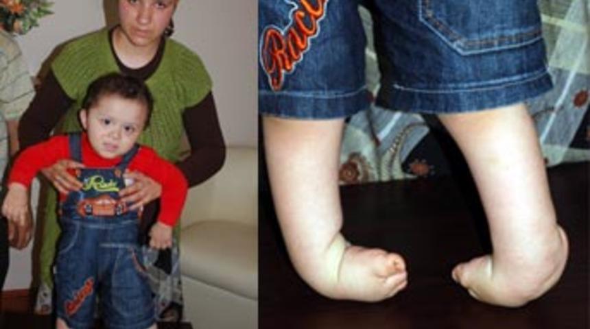 Ters ayaklı 2 yaşındaki Sezer'in dramı