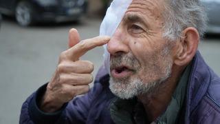 Yüzü eriyen adamın yardım çığlığı: Suratım mum gibi eriyor, gözüm akıyor