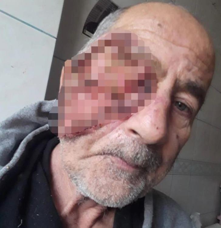 Yüzü eriyen adamın yardım çığlığı: "Suratım mum gibi eriyor, gözüm akıyor" G4