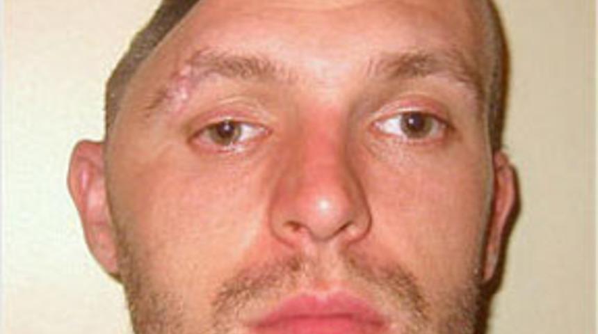 Eksik kafatasıyla yaşıyor