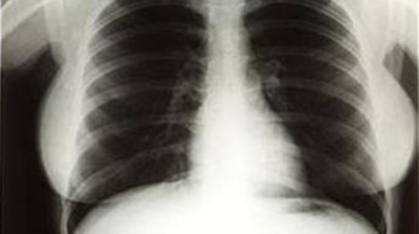 R&ouml;ntgen filmi bile servet