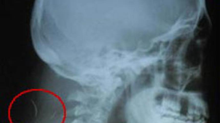 R&ouml;ntgendeki ger&ccedil;ek