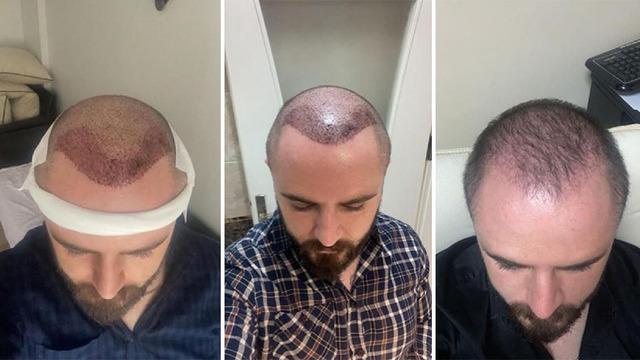 Saç ekimi yaptırdı, sonuç başarısız olunca soluğu mahkemede aldı! Emsal nitelikte karar