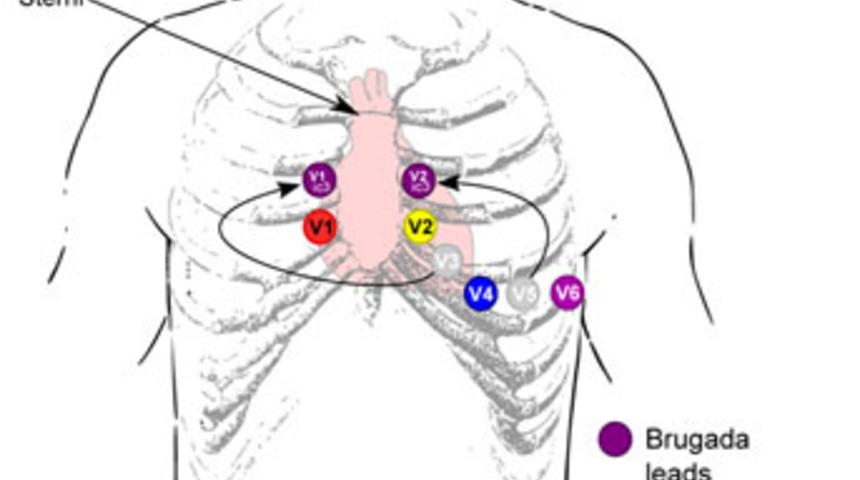 Brugada sendromuna dikkat