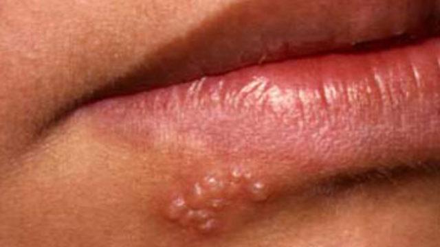 Kansere yeni umut: Uçuk yapan herpes virüsü
