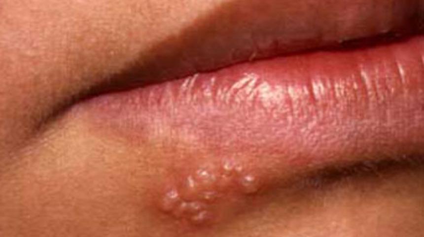 Kansere yeni umut: U&ccedil;uk yapan herpes vir&uuml;s&uuml;