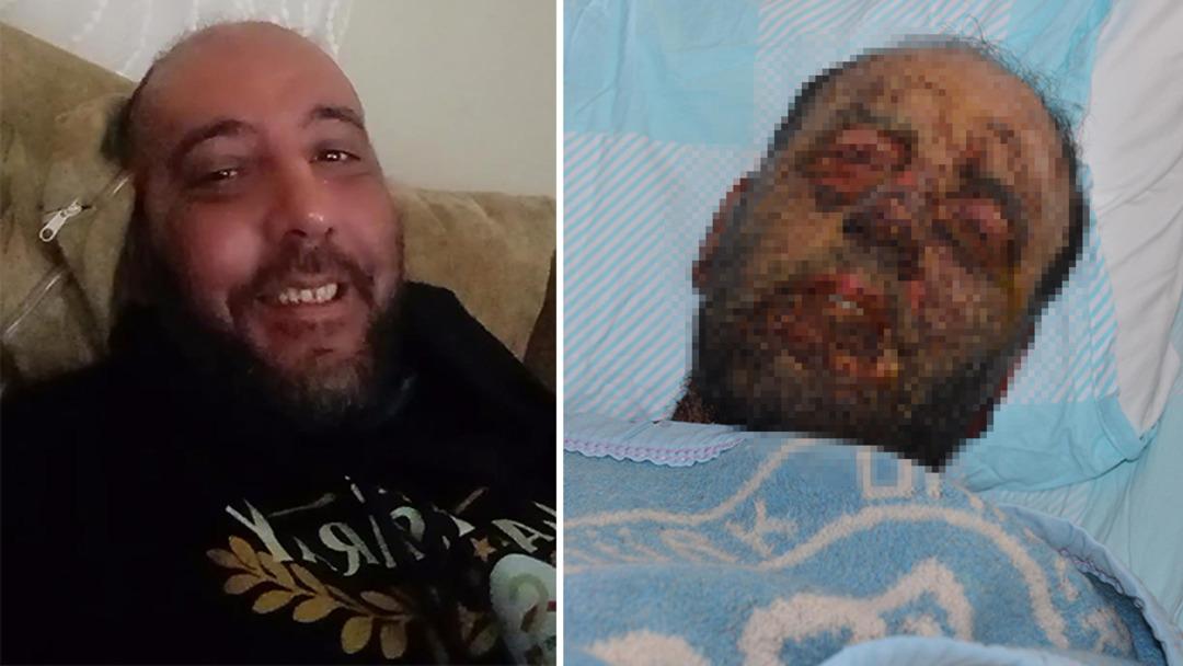 Pemfigus hastalığı 1 yılda y&uuml;z&uuml;n&uuml; tanınmaz hale getirdi! 'Aynaya bakamıyorum'