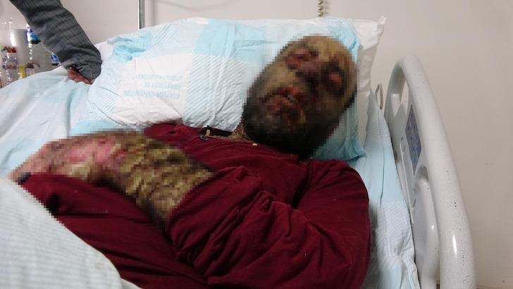 Pemfigus hastalığı 1 yılda yüzünü tanınmaz hale getirdi! 'Aynaya bakamıyorum' G4